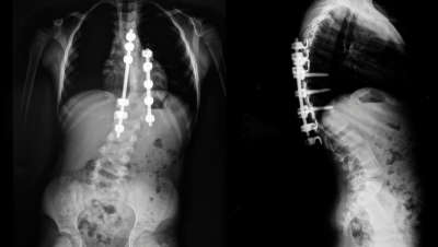 Symptômes, diagnostics et traitement de la scoliose