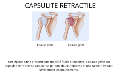 Capsulite épaule saine et épaule gelée