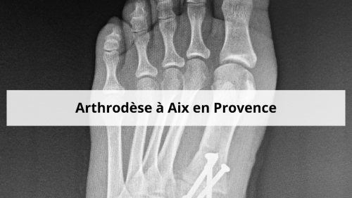 arthrose-du-pied-droit-et-avocat-dommage-corporel-a-aix-en-provence-6-.png arthrose-du-pied-droit-et-avocat-dommage-corporel-a-aix-en-provence-6-.png