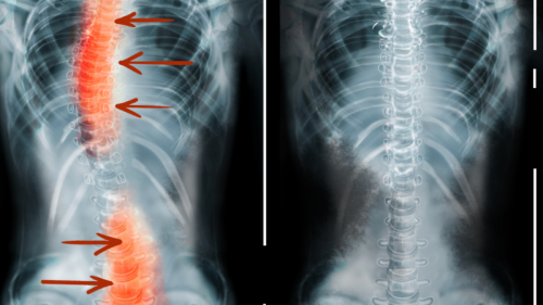 Opération scoliose et erreur médicale cabinet LEXVOX