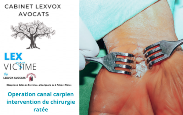 Canal carpien et chirurgie ratée