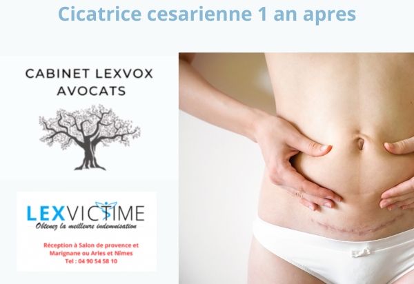 cicatrice-cesarienne-1-an-apres.png