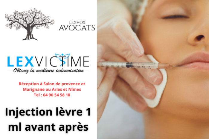 injection-levre-1-ml-avant-apres--1-.png