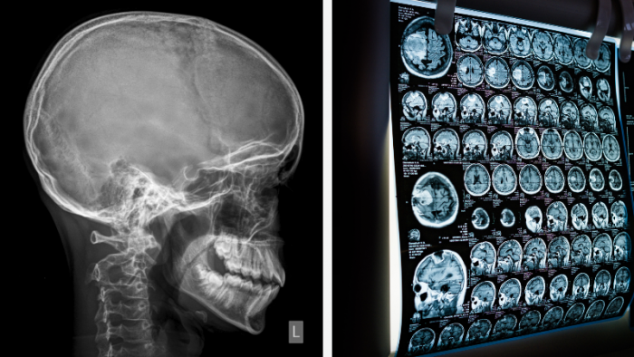 lesion-cerebrale-guerison-a-arles.png