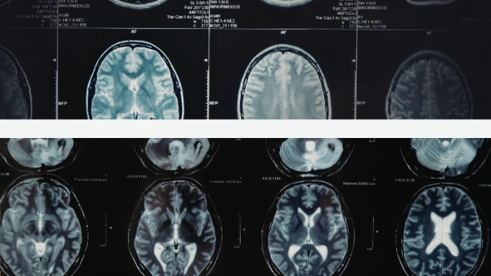 lesion-cerebrale-irm-a-aix-en-provence-1.png