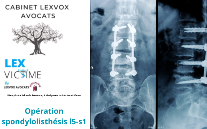 Opération spondylolisthésis l5-s1