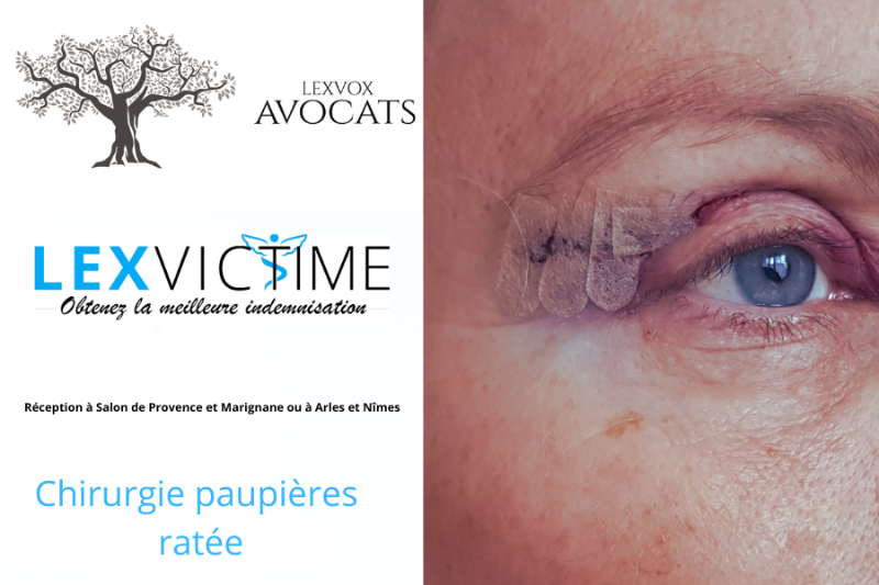 Blépharoplastie ou chirurgie paupières ratée