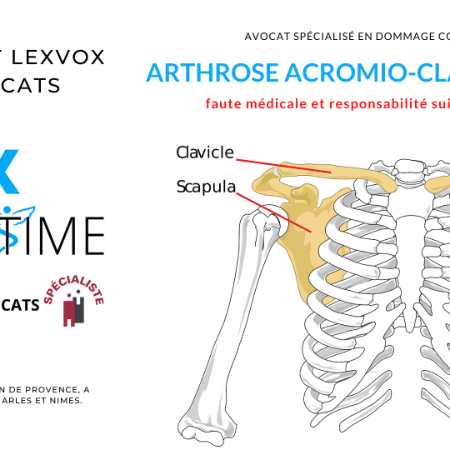 Arthrose acromio-claviculaire causes traitements et faute médical du chirurgien