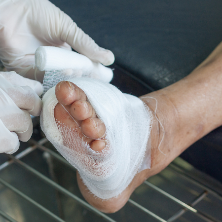 Arthrose du pied droit et avocat dommage corporel à Aix en Provence Arthrose du pied droit et avocat dommage corporel à Aix en Provence