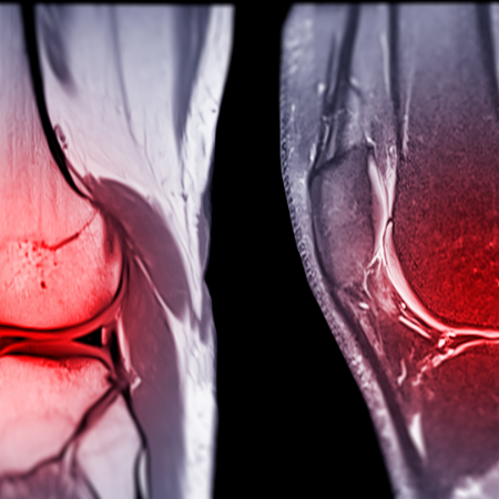 Peut on travailler avec une rupture des ligaments croisés        