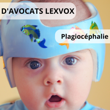 Plagiocéphalie modérée