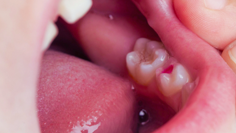 Rage de dent : comment soulager une douleur dentaire