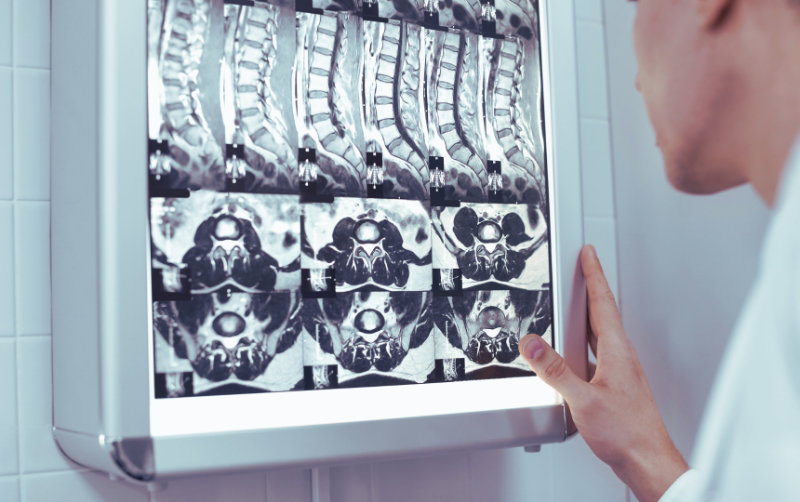IRM rachis examen imagerie lombaire et cervical
