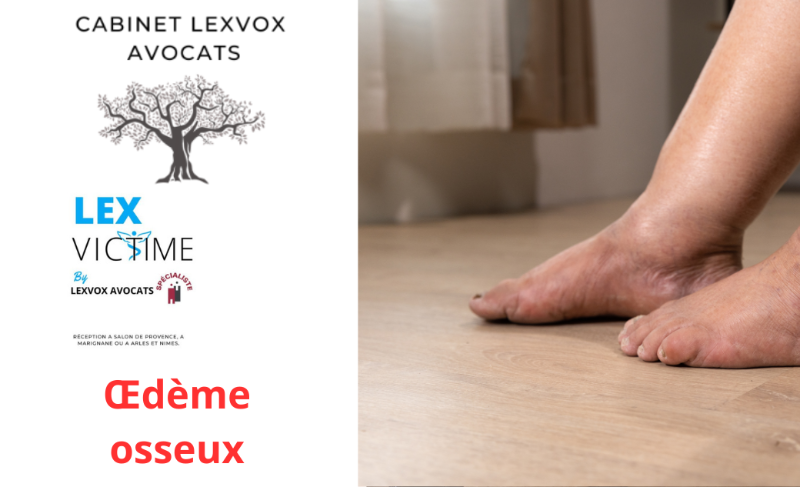 Œdème osseux